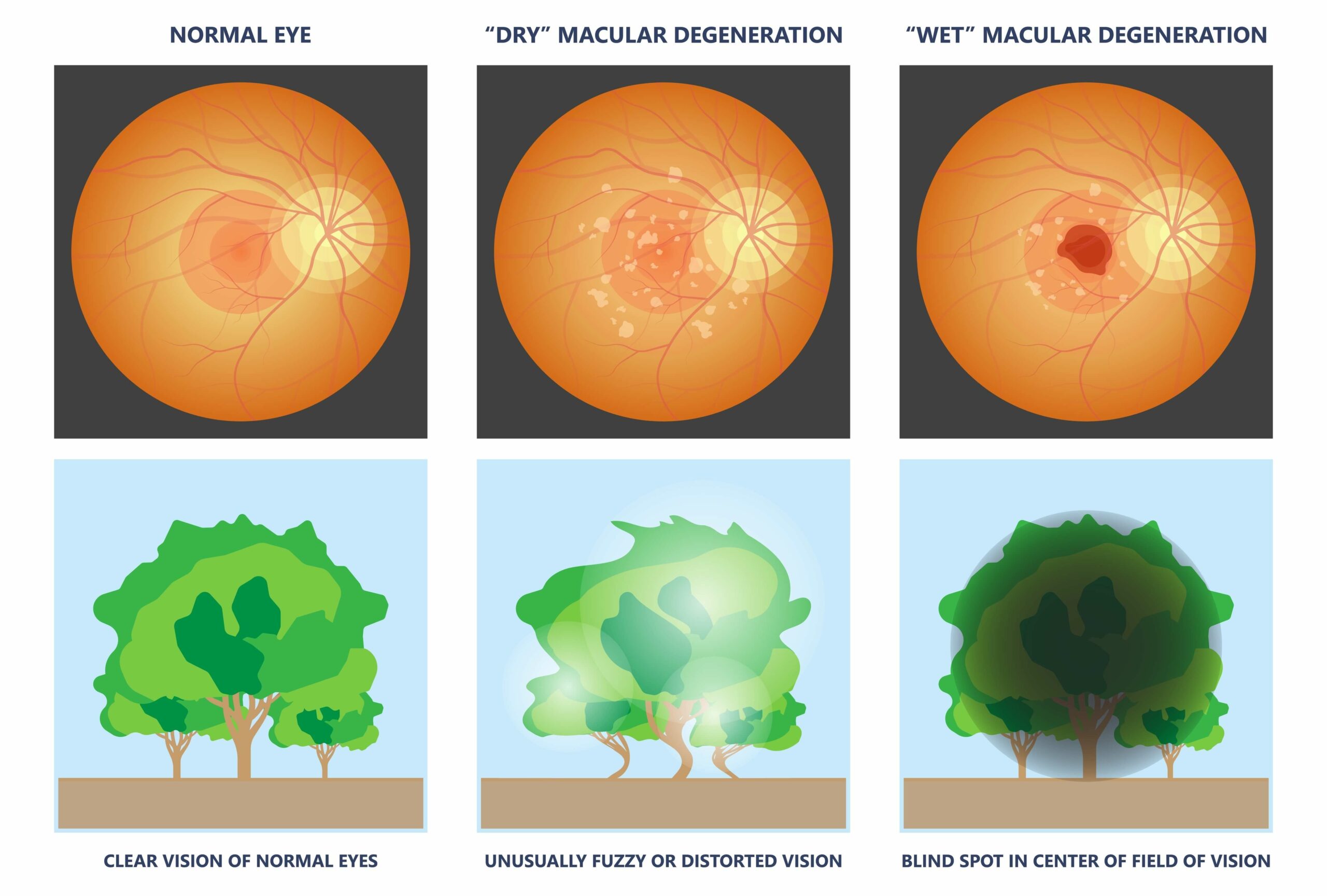 Depiction of normal eye that results in clear vision of normal eyes,'Dry' macular degeneration results in unusually fuzzy or distorted vision and 'Wet' macular degeneration results in blind spot in center of field of-vision